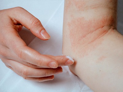 Người bị bệnh eczema nên “khắc cốt ghi tâm” 4 lời khuyên này!
